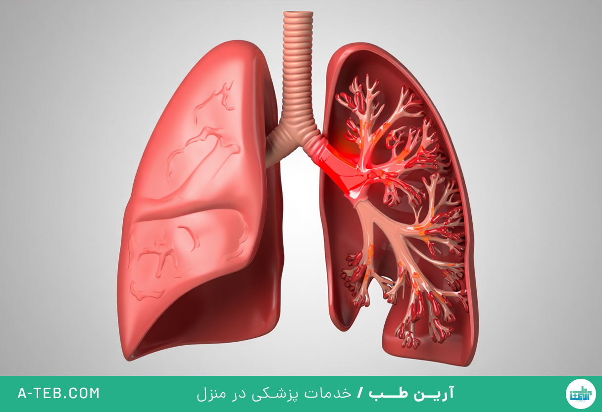 آلرژی تنفسی