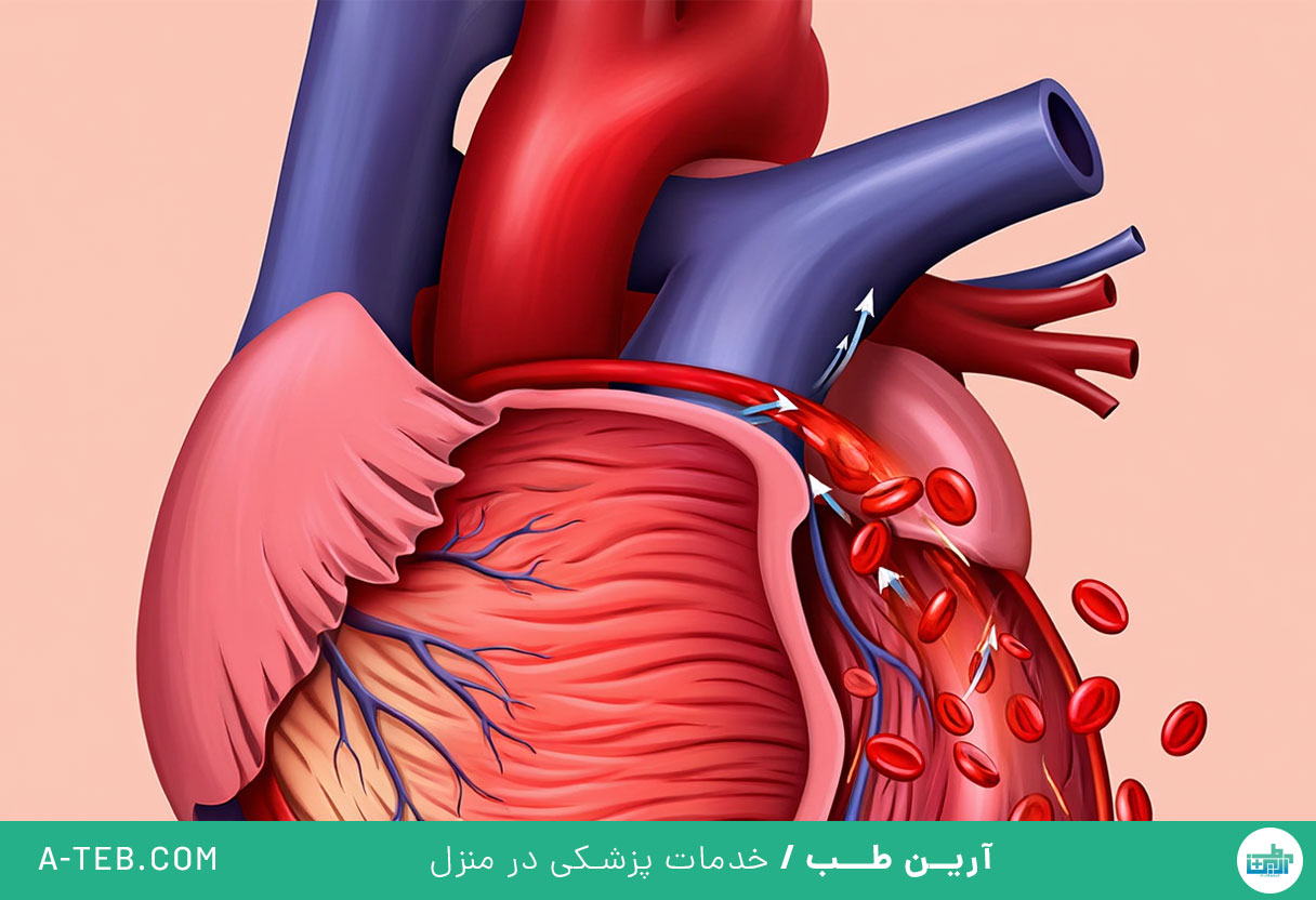 نارسایی سمت راست قلب