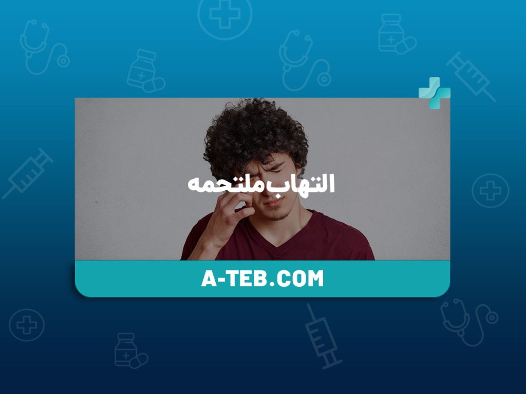 التهاب ملتحمه