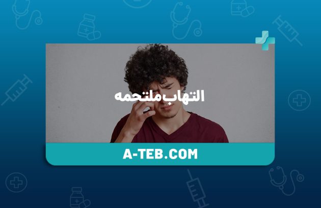 التهاب ملتحمه