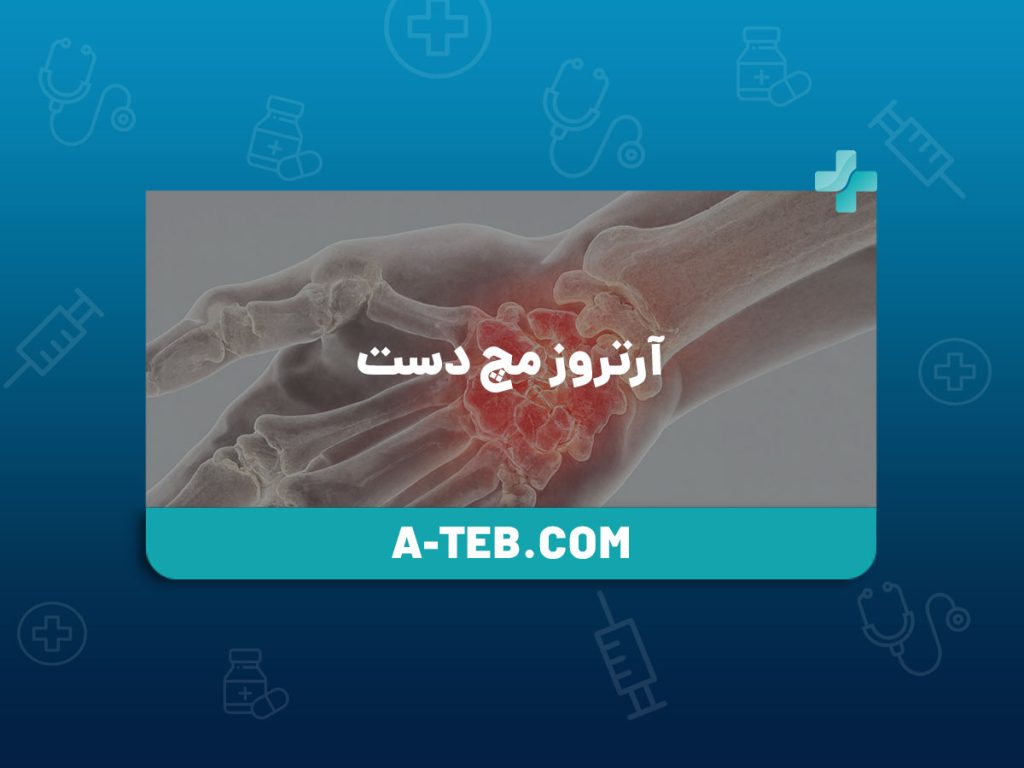 آرتروز مچ دست