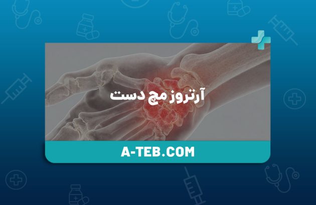 آرتروز مچ دست
