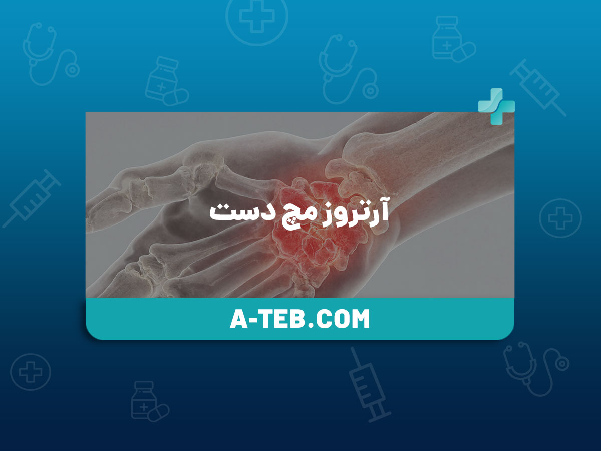آرتروز مچ دست