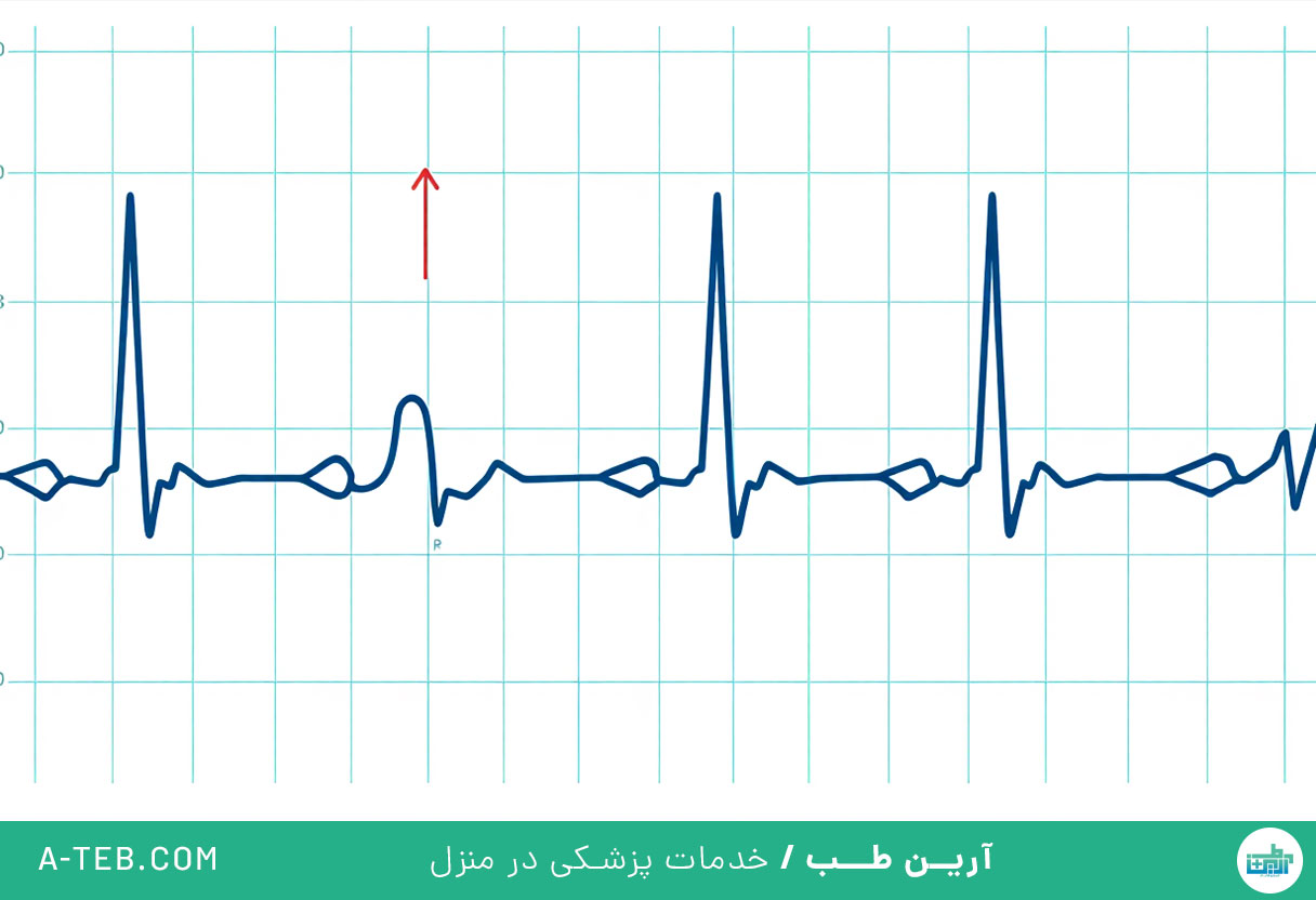 سندرم سینوس بیمار