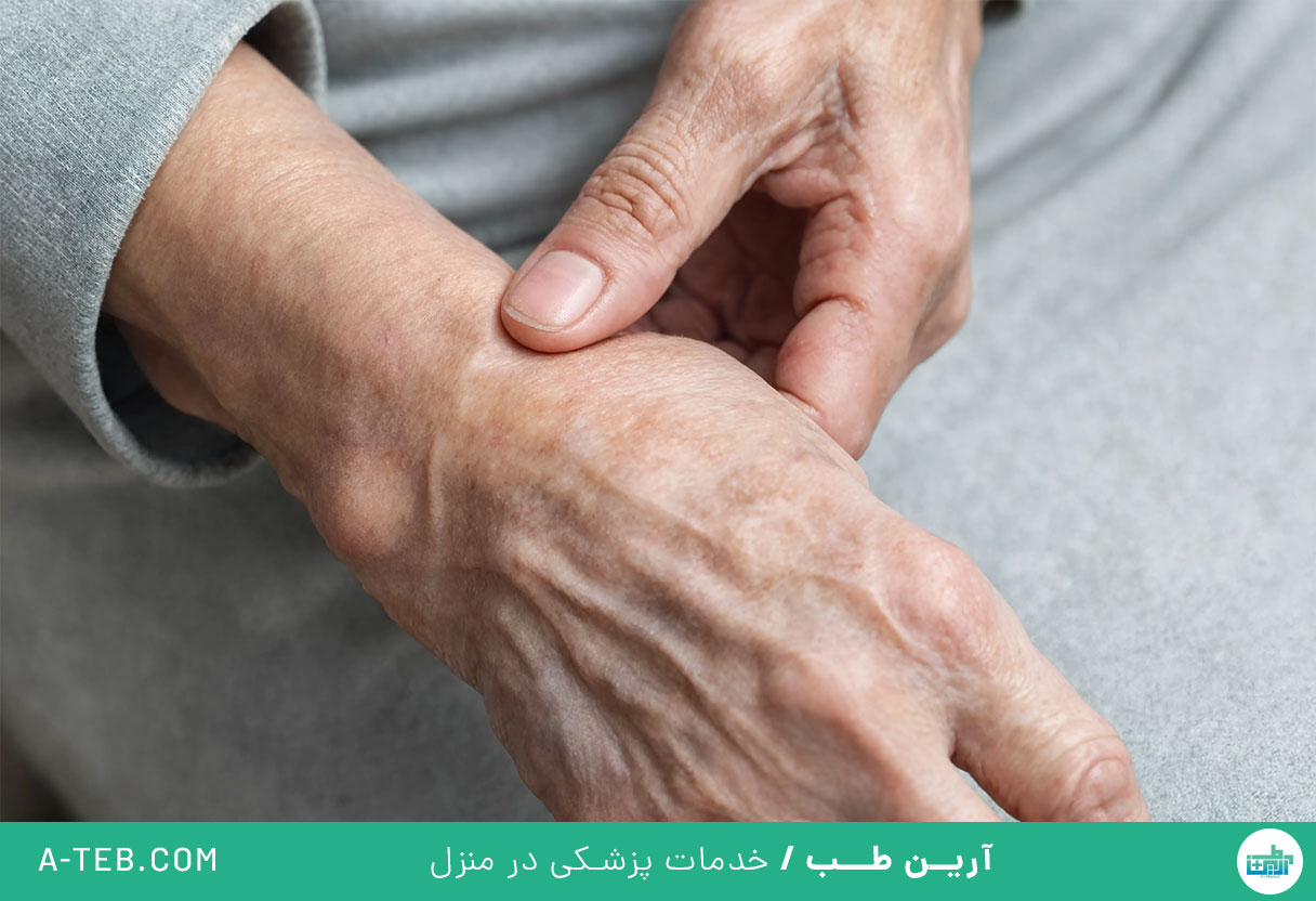 آرتروز مچ دست