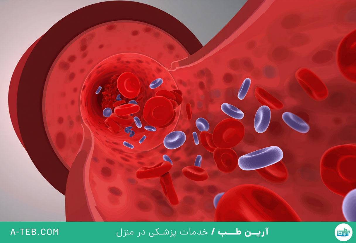 درمان اختلالات انعقادی