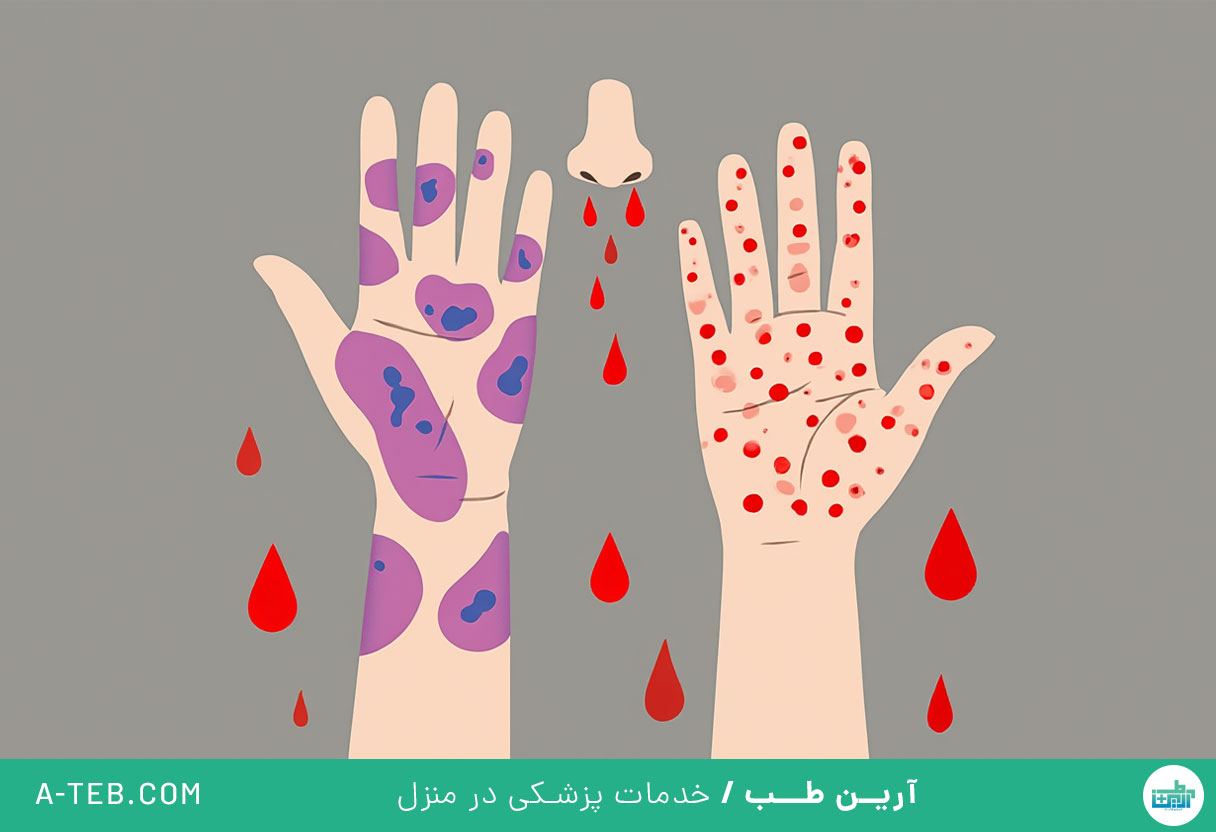 درمان ترومبوسیتوپنی