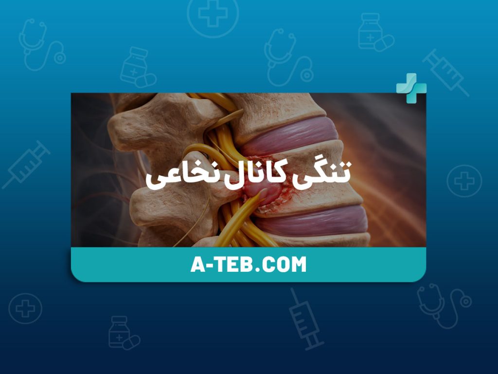 تنگی کانال نخاعی
