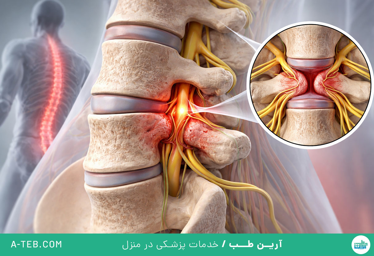 درمان تنگی کانال نخاعی