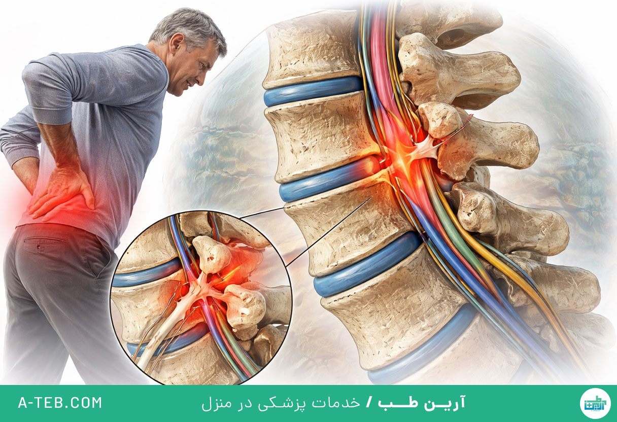 علائم تنگی کانال نخاعی