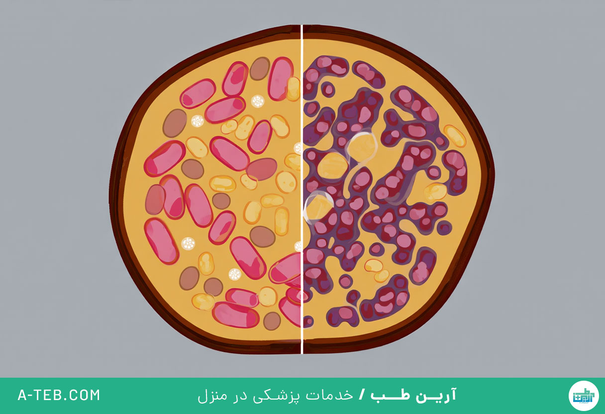درمان سندرم میلودیسپلاستیک