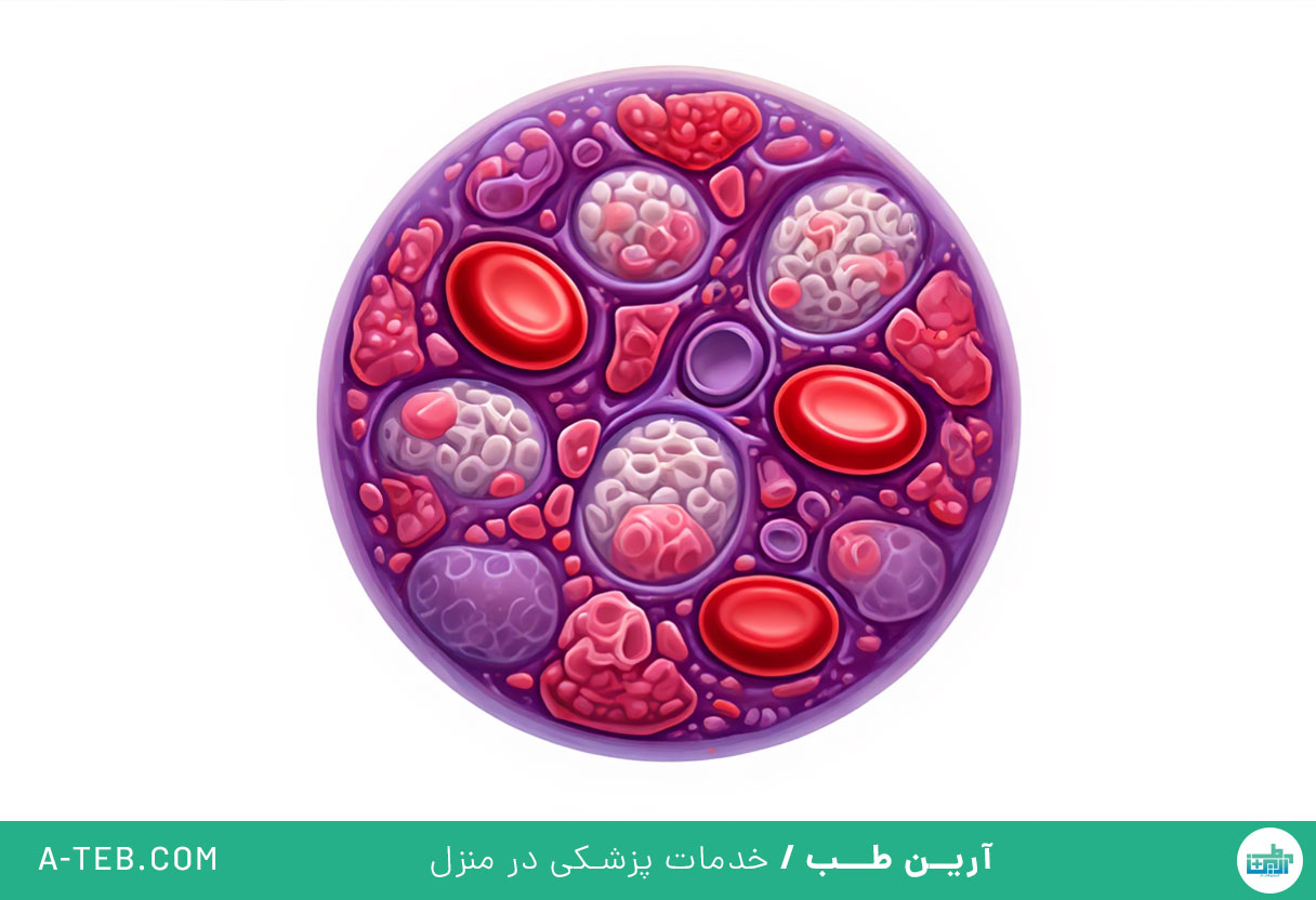 علت سندرم میلودیسپلاستیک