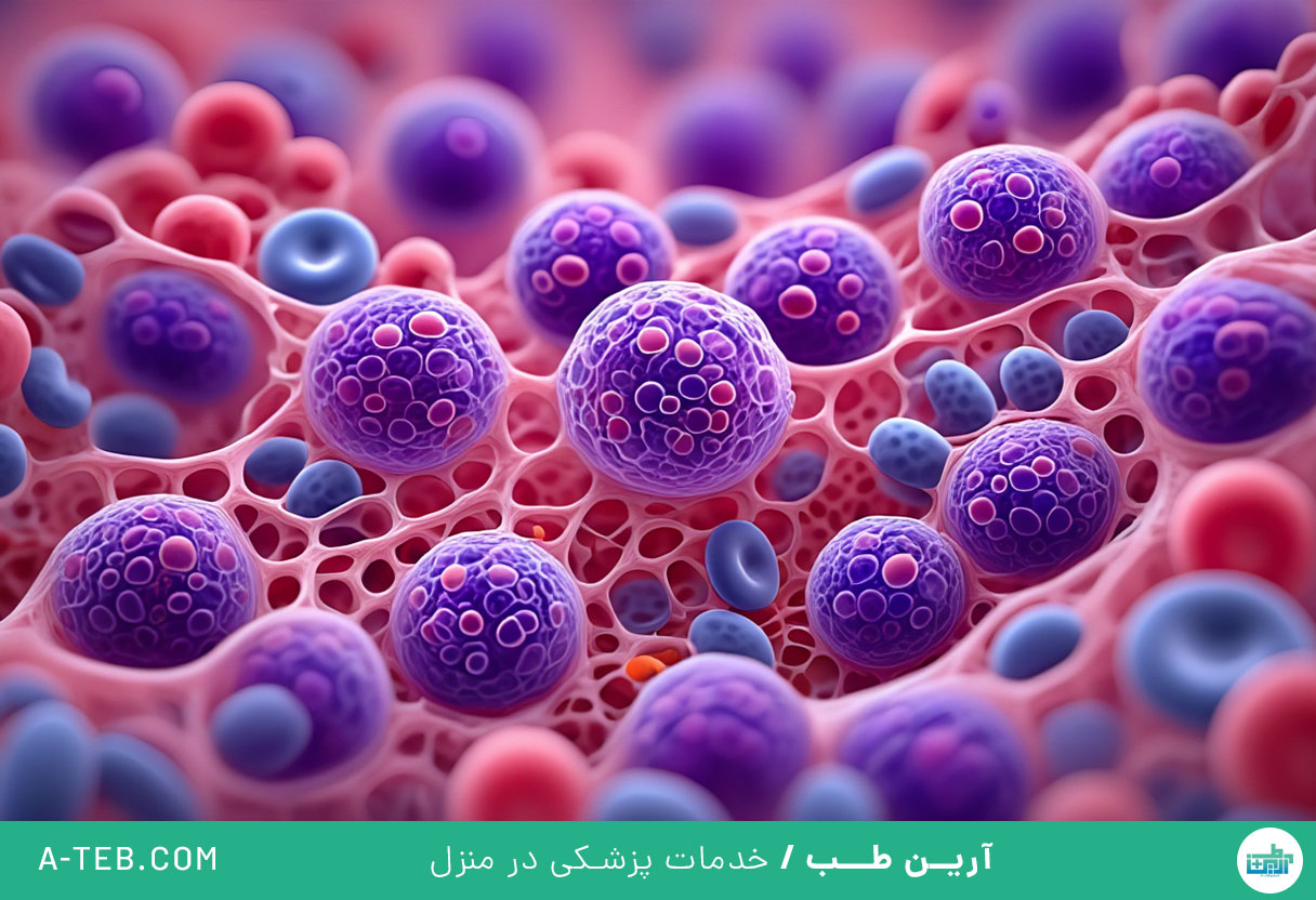 مولتیپل میلوما