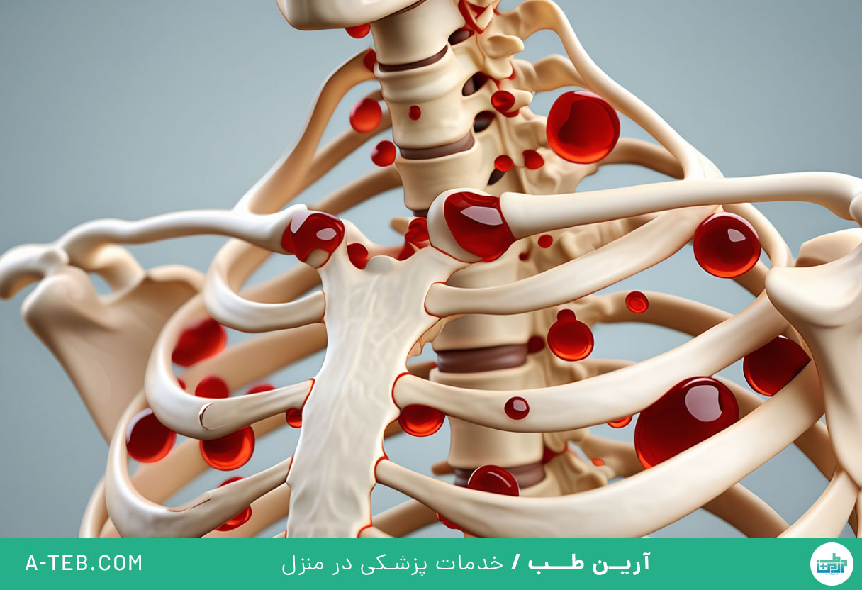 مولتیپل میلوما