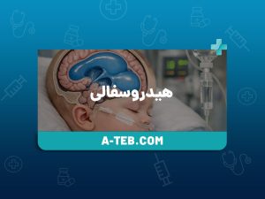 هیدروسفالی