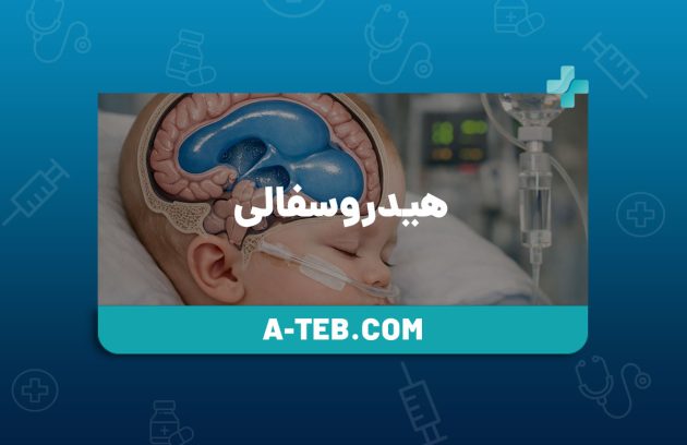 هیدروسفالی