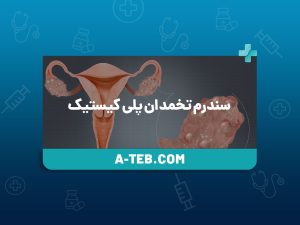 سندرم تخمدان پلی کیستیک