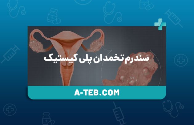 سندرم تخمدان پلی کیستیک