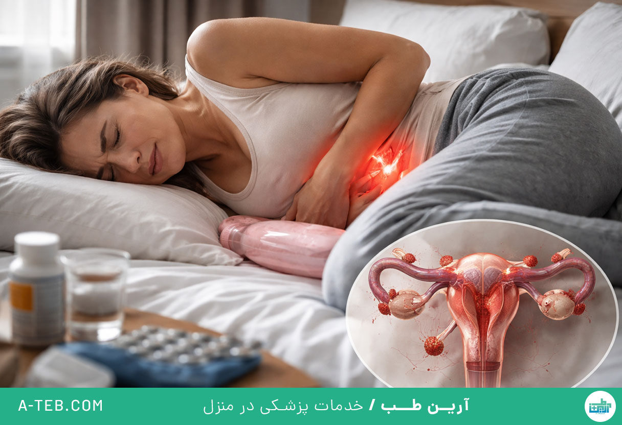 درمان اندومتریوز