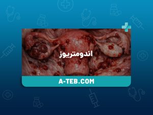 اندومتریوز