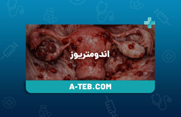 اندومتریوز