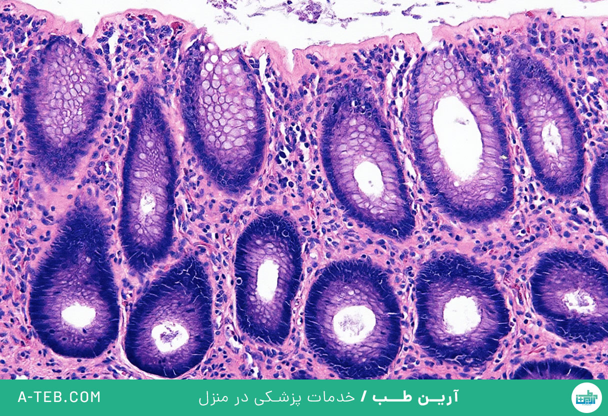 کولیت میکروسکوپی
