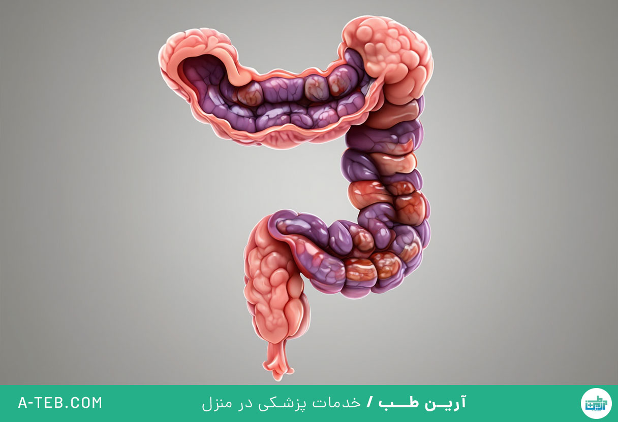 کولیت ایسکمیک