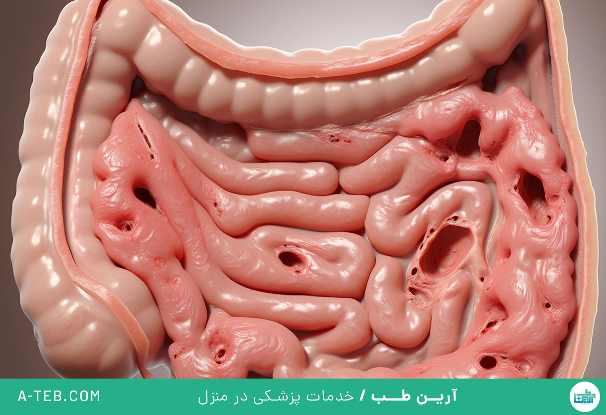 کولیت اولسراتیو