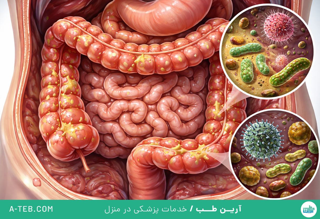 کولیت عفونی