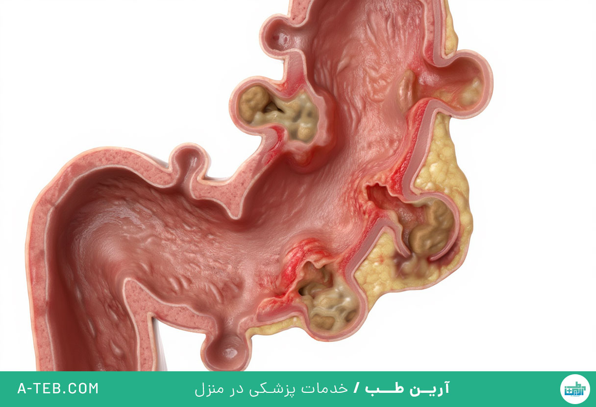 دیورتیکولیت