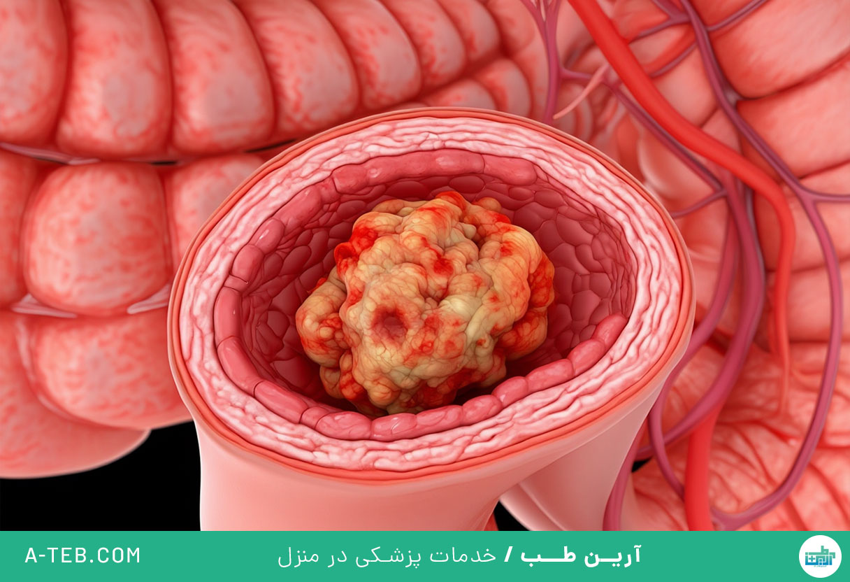 سرطان روده بزرگ