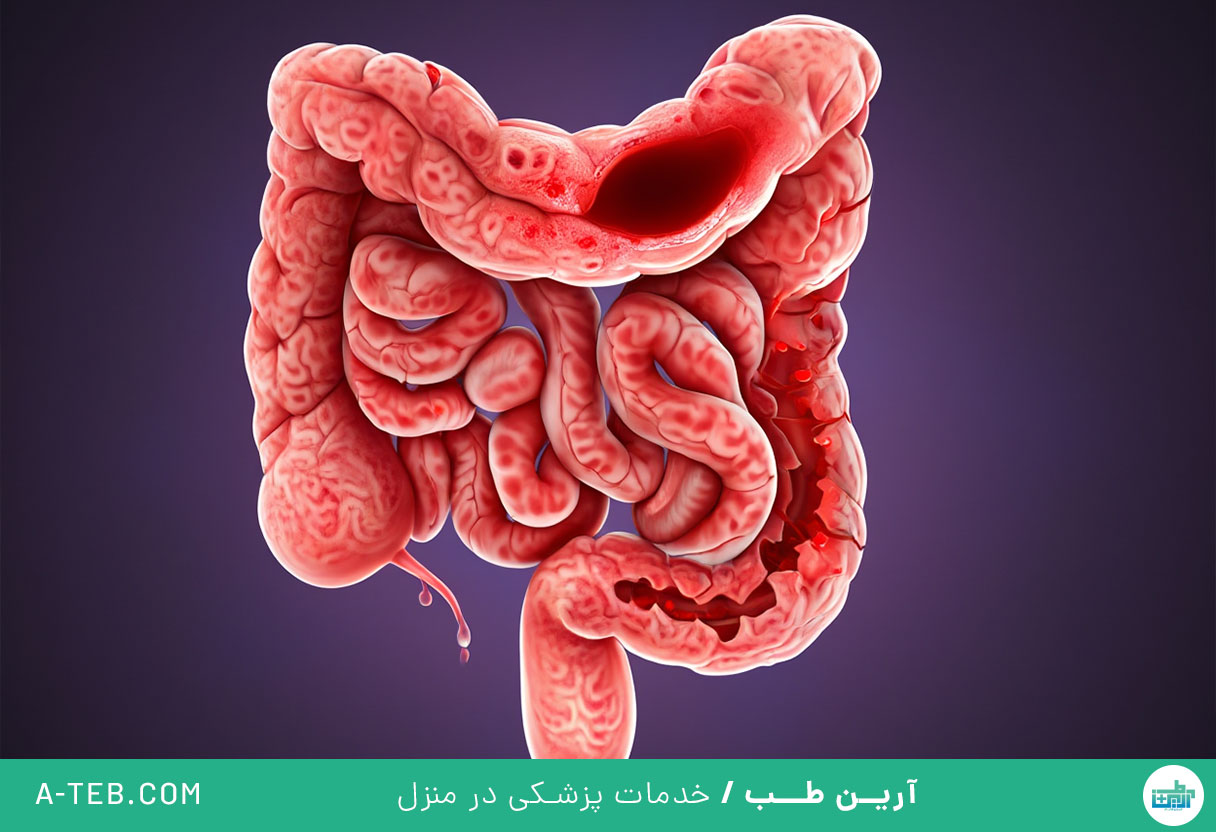 کولیت اولسراتیو