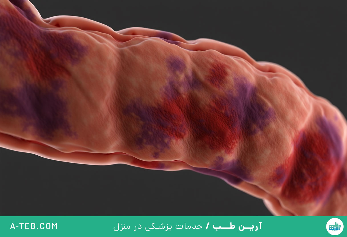 کولیت ایسکمیک