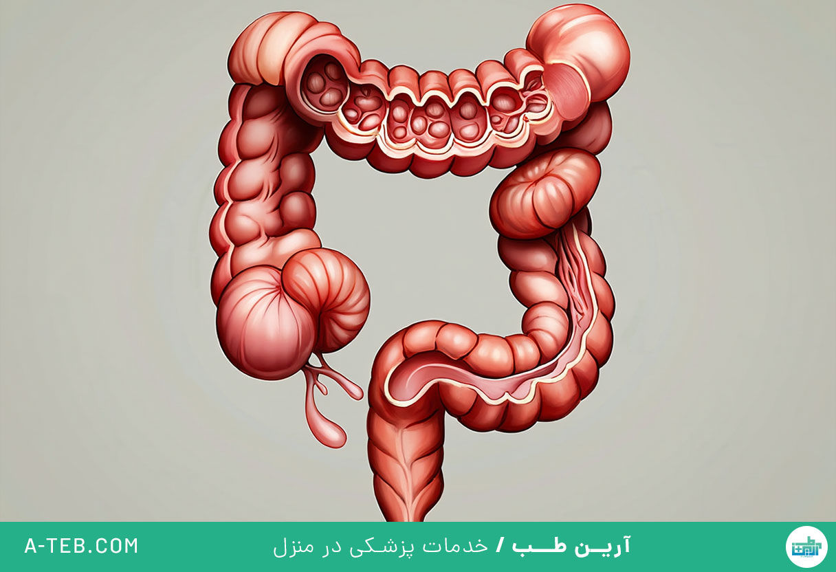 دیورتیکولوز