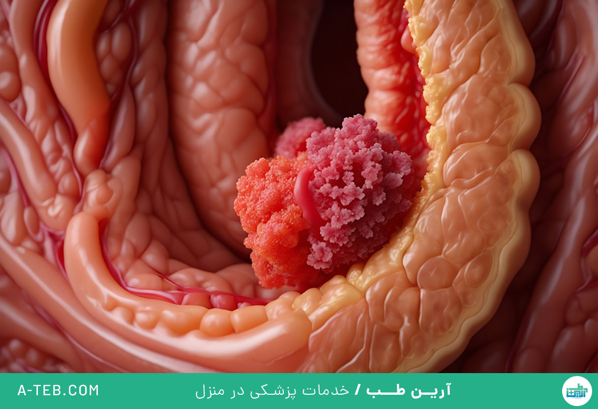 سرطان روده بزرگ