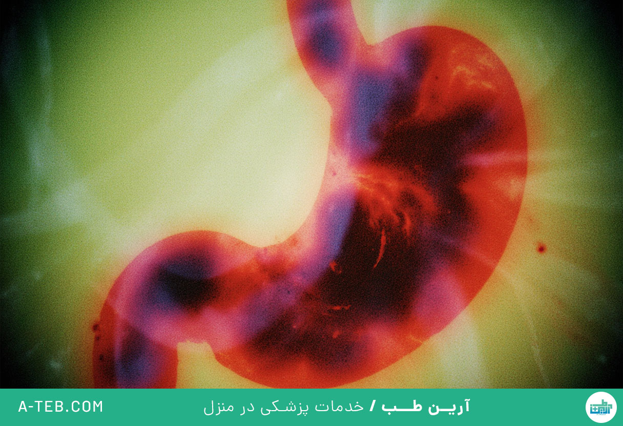 آنفولانزای معده