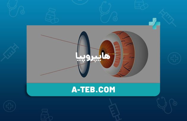 هایپروپیا