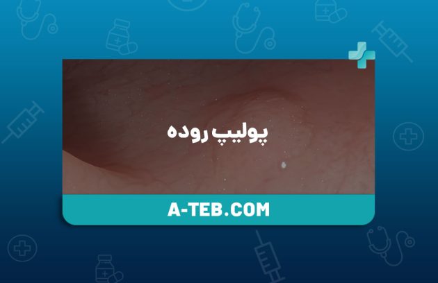 پولیپ روده