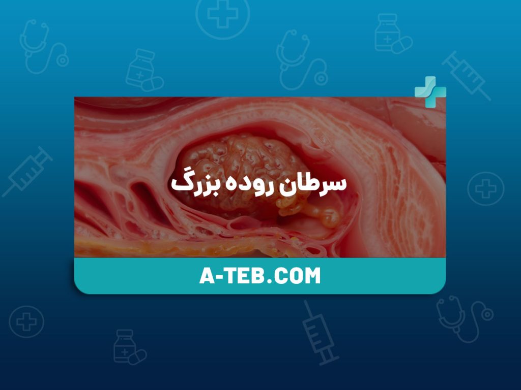 سرطان روده بزرگ