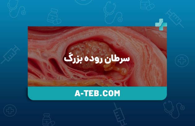 سرطان روده بزرگ