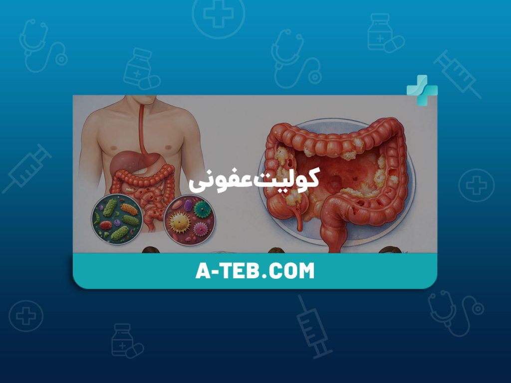 کولیت عفونی