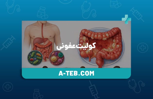 کولیت عفونی