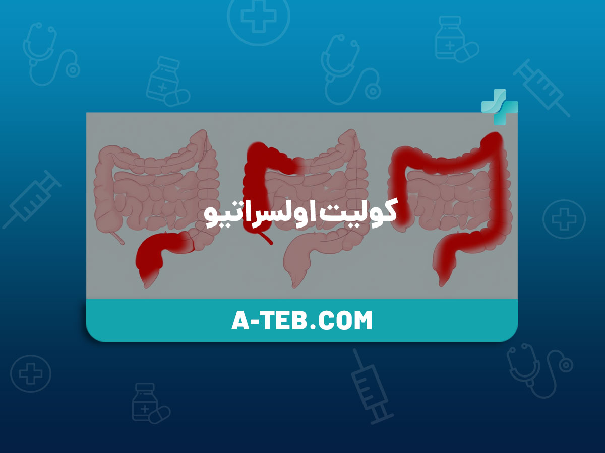 کولیت اولسراتیو