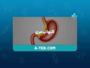 التهاب مری