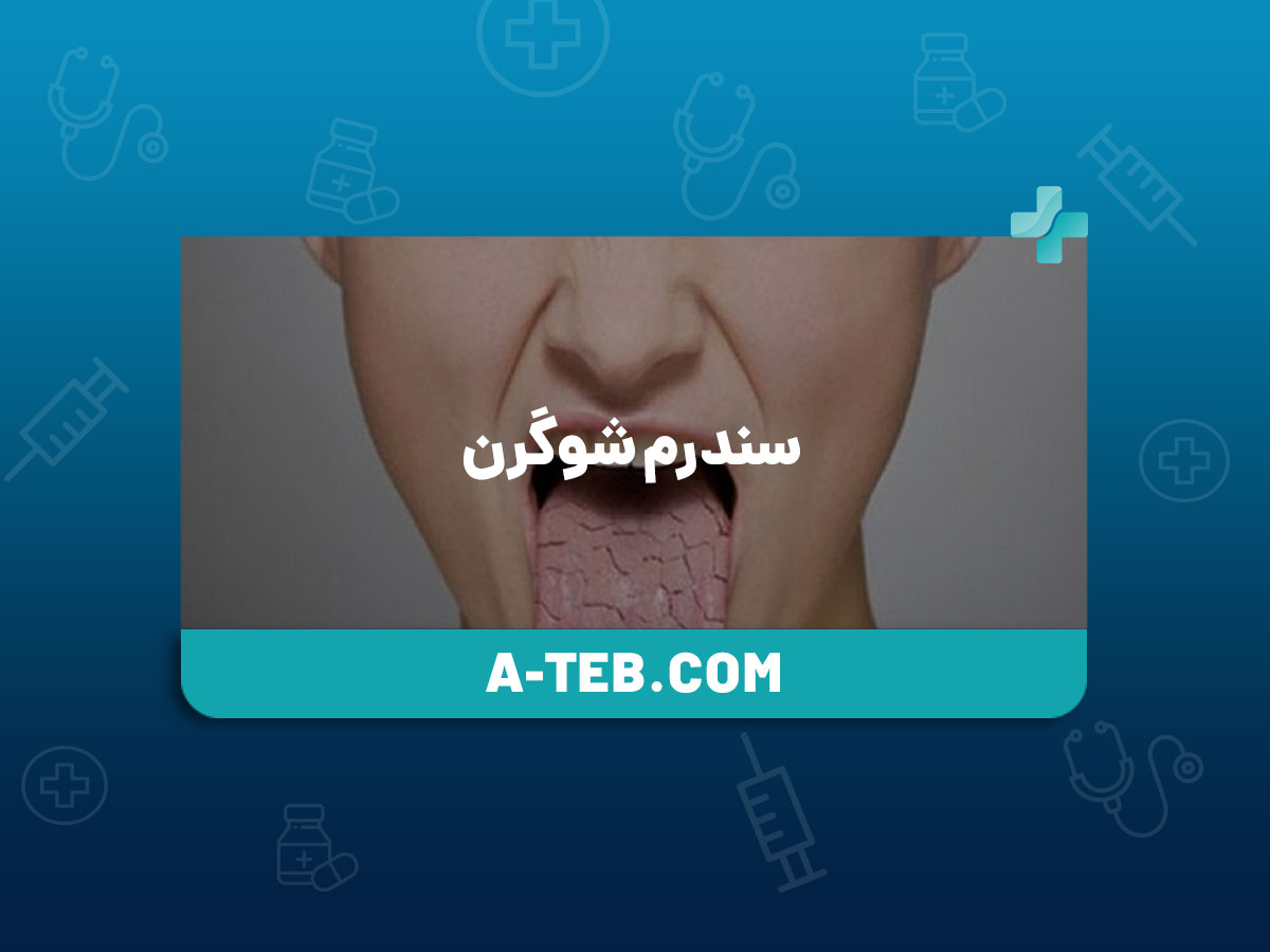 سندرم شوگرن
