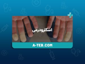 اسکلرودرمی