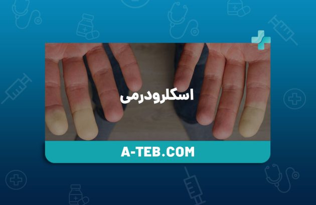 اسکلرودرمی