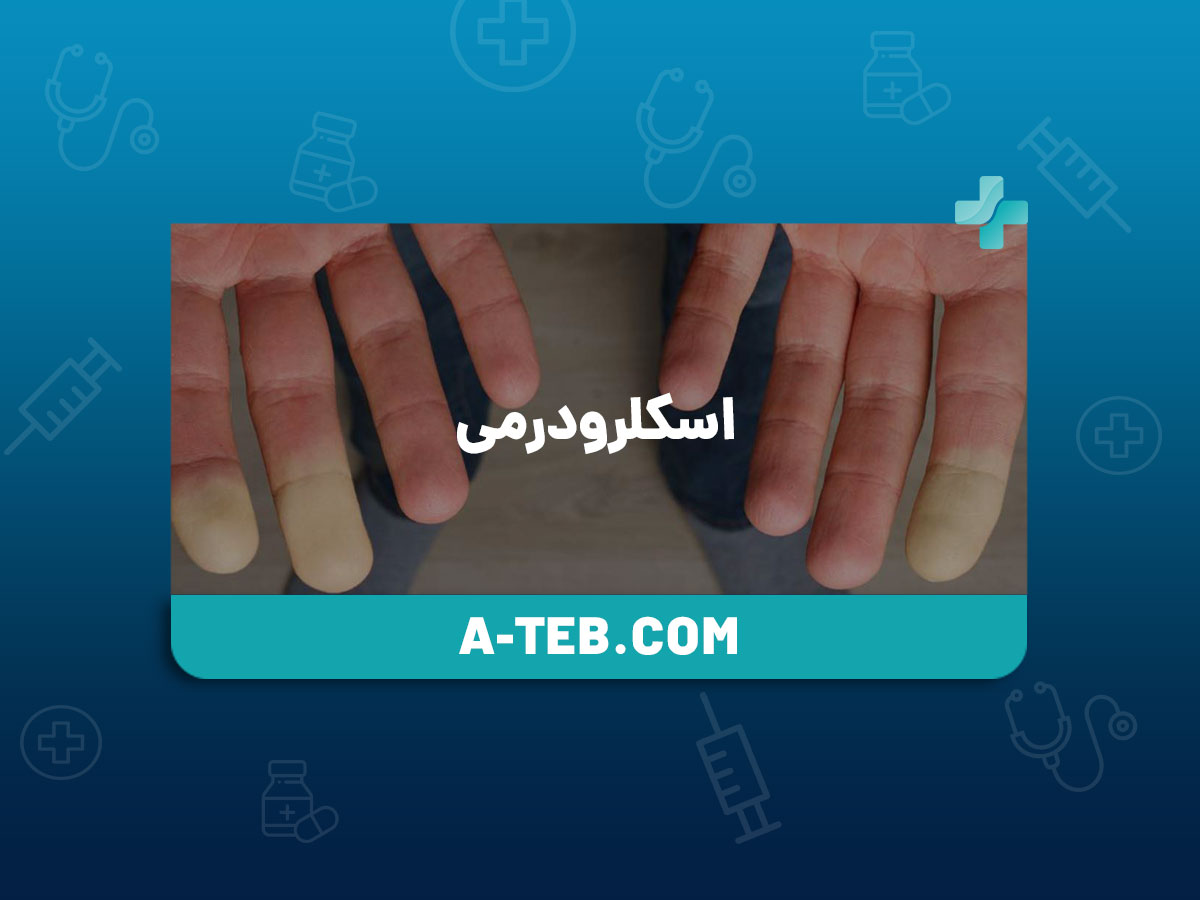 اسکلرودرمی