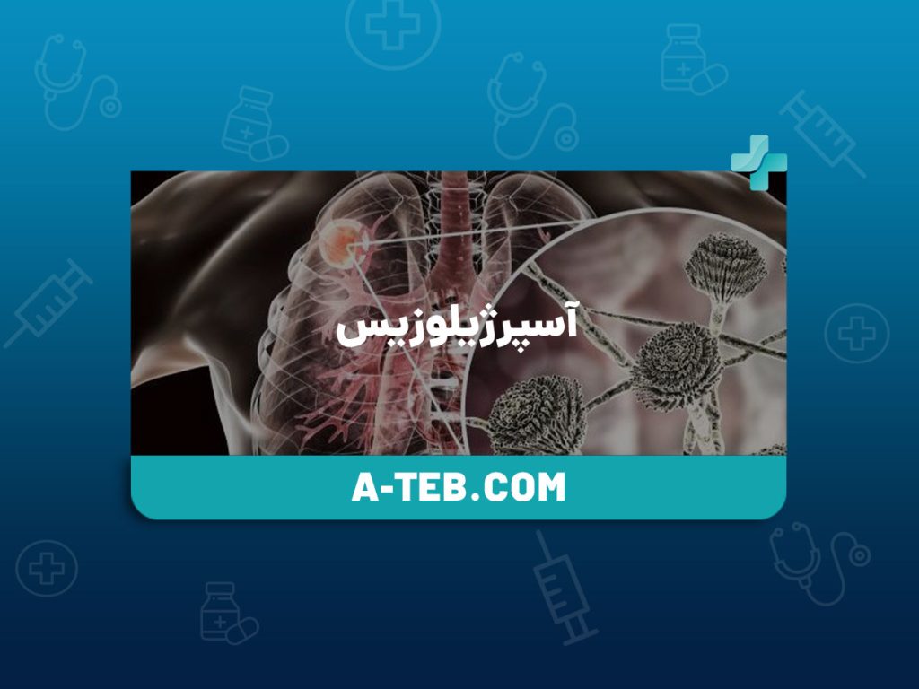 آسپرژیلوزیس