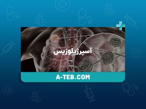 آسپرژیلوزیس